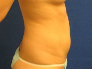 Smart Liposuction Before & After case 16