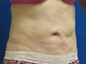 Smart Liposuction Before & After case 17
