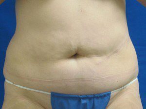 Smart Liposuction Before & After case 17
