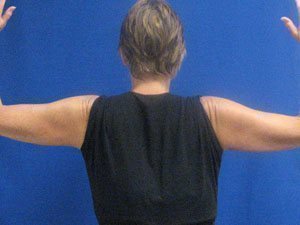 Smart Liposuction Before & After case 18