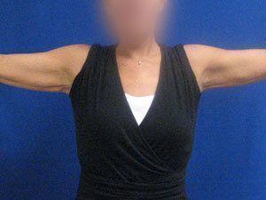 Smart Liposuction Before & After case 18