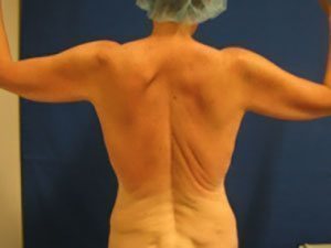 Smart Liposuction Before & After case 18