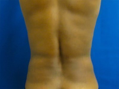 Smart Liposuction Before & After case 5