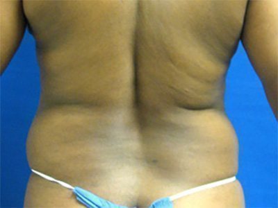 Smart Liposuction Before & After case 5