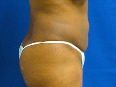 Smart Liposuction Before & After case 6