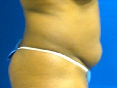 Smart Liposuction Before & After case 6