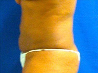 Smart Liposuction Before & After case 6