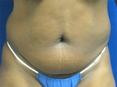 Smart Liposuction Before & After case 6