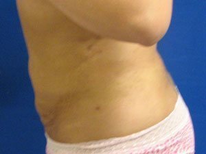 Smart Liposuction Before & After case 7