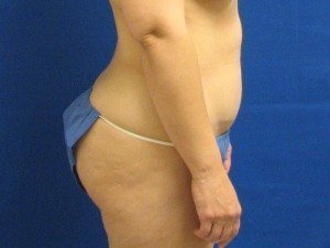 Smart Liposuction Before & After case 8