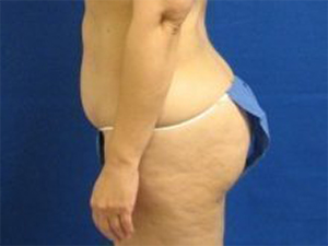 Smart Liposuction Before & After case 8