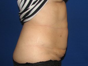 Smart Liposuction Before & After case 9