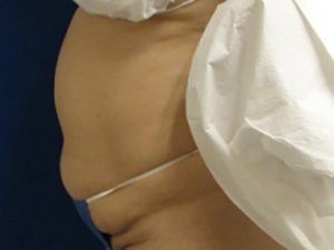 Smart Liposuction Before & After case 9