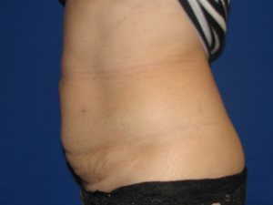 Smart Liposuction Before & After case 9
