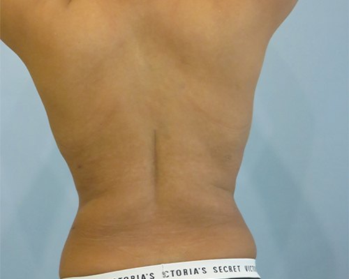 Smart Liposuction | Liposuction Before & After case 2