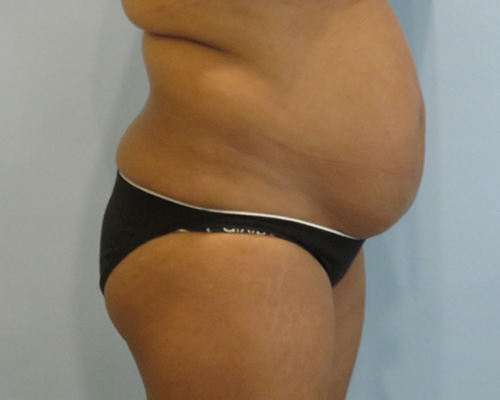 Smart Liposuction | Liposuction Before & After case 2