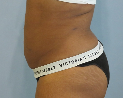 Smart Liposuction | Liposuction Before & After case 2