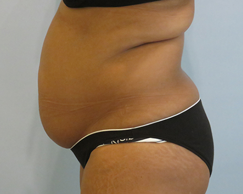 Smart Liposuction | Liposuction Before & After case 2