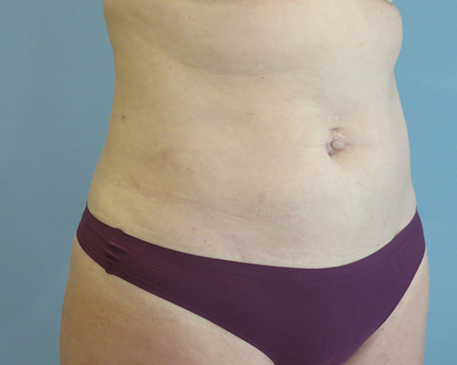 Smart Liposuction | Liposuction Before & After Case 3