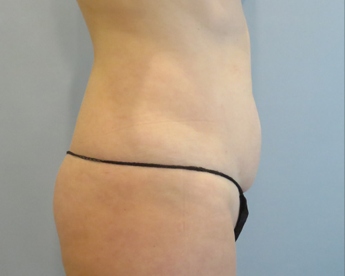 Smart Liposuction | Liposuction Before & After Case 3