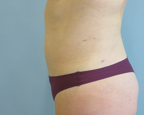 Smart Liposuction | Liposuction Before & After Case 3