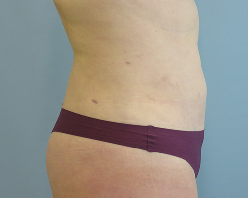 Smart Liposuction | Liposuction Before & After Case 3