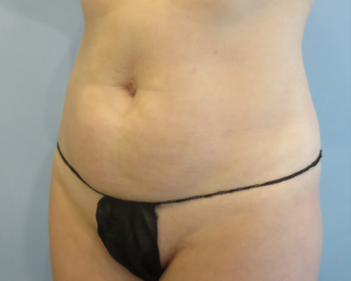 Smart Liposuction | Liposuction Before & After Case 3