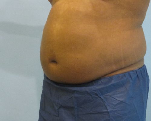 Smart Liposuction | Liposuction Before and After Case 4