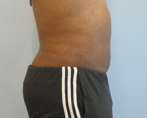 Smart Liposuction | Liposuction Before and After Case 4
