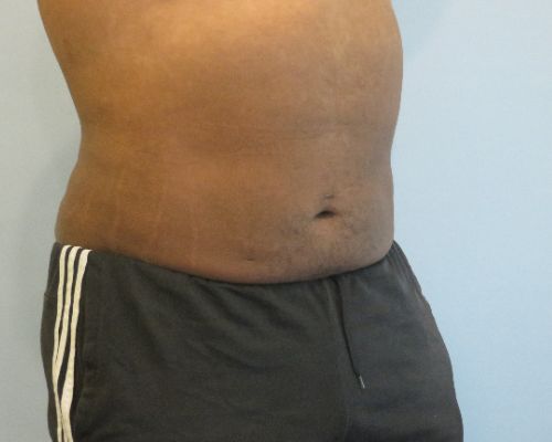 Smart Liposuction | Liposuction Before and After Case 4