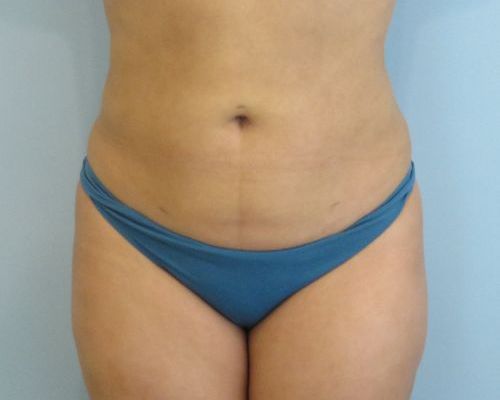 Smart Liposuction | Liposuction Case 1