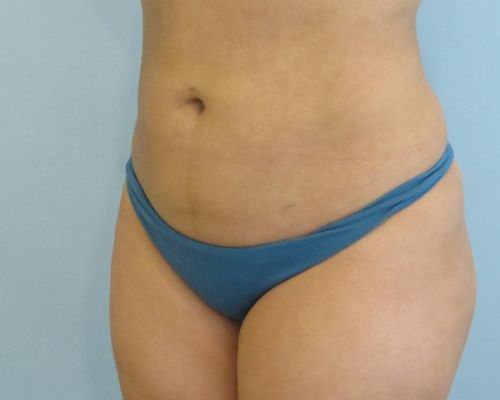 Smart Liposuction | Liposuction Case 1