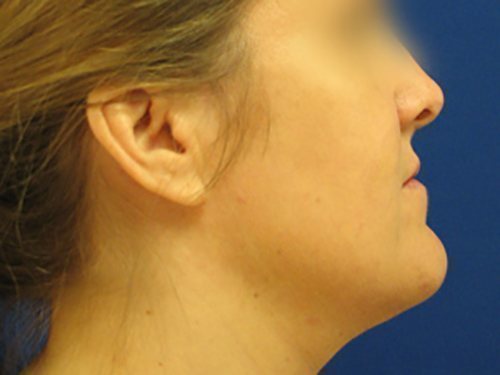 SmartLipo Neck Before & After case 1