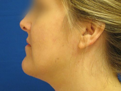 SmartLipo Neck Before & After case 1