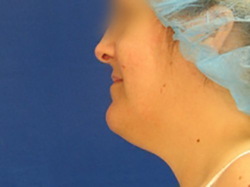 SmartLipo Neck Before & After case 1