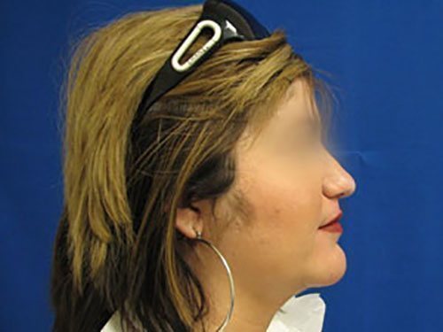 SmartLipo Neck Before & After case 2