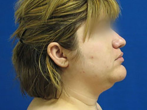SmartLipo Neck Before & After case 2