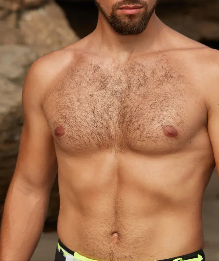 Treating Gynecomastia with Excess Tissue Excision banner