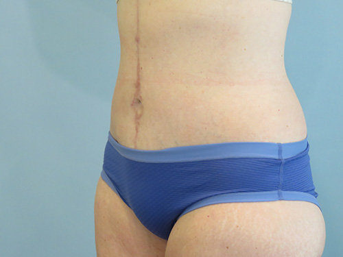 Tummy Tuck | 360 Body Lift Before & After case 10