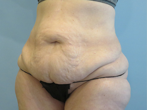 Tummy Tuck | 360 Body Lift Before & After case 10