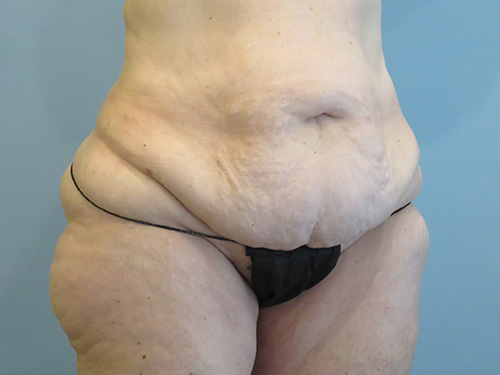 Tummy Tuck | 360 Body Lift Before & After case 10