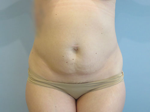 Tummy Tuck | 360 Body Lift Before & After case 11