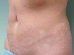 Tummy Tuck | 360 Body Lift Before & After case 13