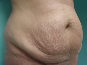 Tummy Tuck | 360 Body Lift Before & After case 13