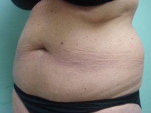Tummy Tuck | 360 Body Lift Before & After case 14