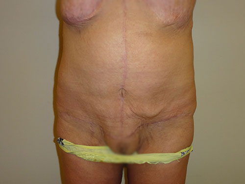 Tummy Tuck | 360 Body Lift Before & After case 21