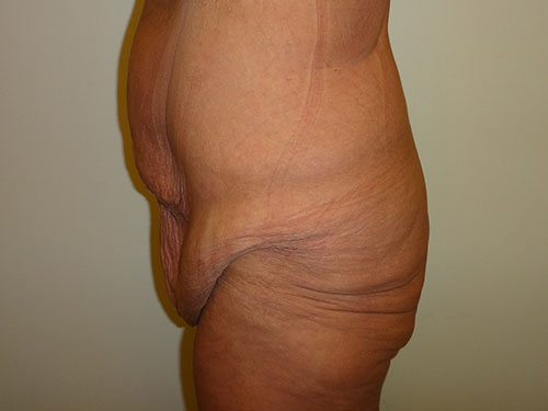 Tummy Tuck | 360 Body Lift Before & After case 21