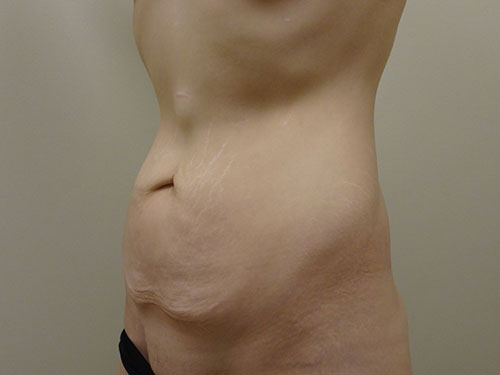 Tummy Tuck | 360 Body Lift Before & After case 22