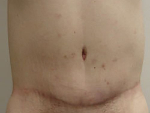 Tummy Tuck | 360 Body Lift Before & After case 23