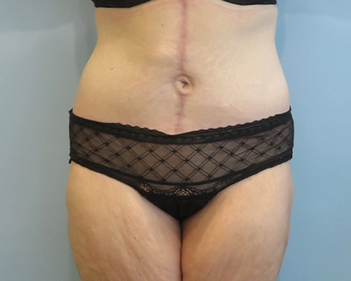 Tummy Tuck | 360 Body Lift Before & After case 25